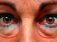 Dark Circles And Bags Under The Eyes Can Disappear By Using This Natural Treatment!