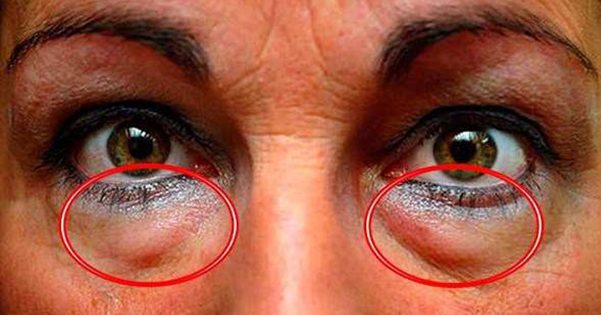 3-treatments-for-periorbital-dark-circles-dermatology-times-and