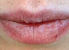 Do You Often Have Dry Lips Attention, It is Important to Know This