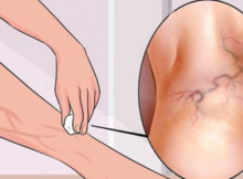 One Simple Ingredient That Will Help You Get Rid of Varicose Veins Forever!