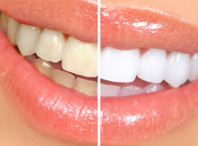 Why You Should Make Your Teeth Whiter Using Home Remedies?