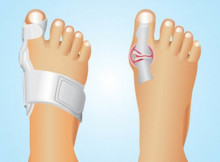 Bunions can be removed entirely Naturally!