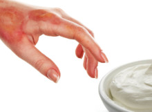 Ways of Using Sour Cream for Healing Just About Every Type of Burn