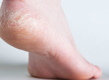 Yes, Dry, Cracked and Itchy Feet Could be treated on a Natural Way