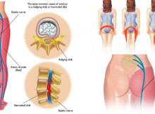 6 natural methods for relieving Sciatica pain