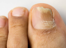 How to Deal With Toenail Fungus?