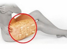 This magical remedy will help you get rid of cellulite in few days!