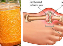 Cure Gout Forever By Using This Natural Treatment