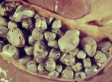 Effective Way of Destroying 1000 Gallstones in 24 Hours (RECIPE)