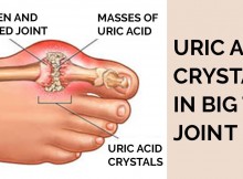 How to Control Uric Acid Levels