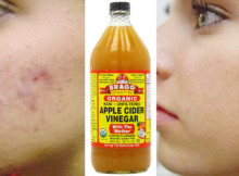 Put Apple Cider Vinegar on Your Face and See What Happens To Toxins, Eczema, and Age Spots