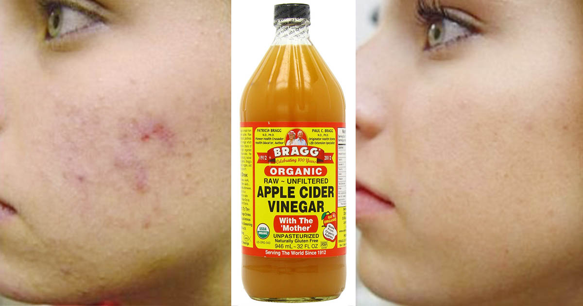 how-to-use-apple-cider-vinegar-for-acne-how-to-cure-acne-acne-marks