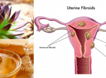 The combination of the two ingredients that can help you SAY GOODBYE to cysts and fibroids!