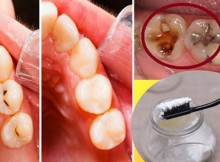 4 Basic Steps That Will Easily Remove Your Cavities!