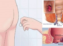 Doctors still can not find the explanation This simple remedy can CURE your hemorrhoids in just 20 minutes !!!