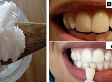 Gargle With One Simple Ingredient and See What Happens To Your Teeth