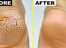 Grandma Told Me This Trick. It Healed My Cracked Heels in Just 1 Night