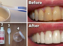 How To Get Rid Of Plaque and Whiten Your Teeth Without Expensive Treatments