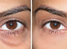 How to Get Rid of Stubborn Eye Bags with Essential Oil and Aloe Vera