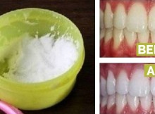 Make Your Teeth White At Home After Only 3 Minutes. A 100% Proof Of Efficacy