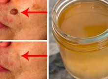 Remove Age Spots, Moles, Warts and Pimples in A Completely Natural Way